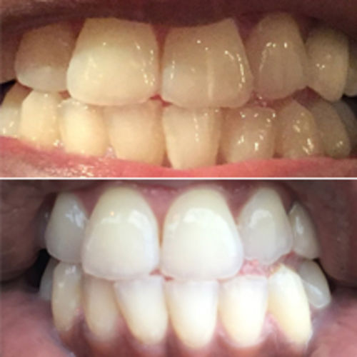 Customer photo review of Teeth Whitening Kit