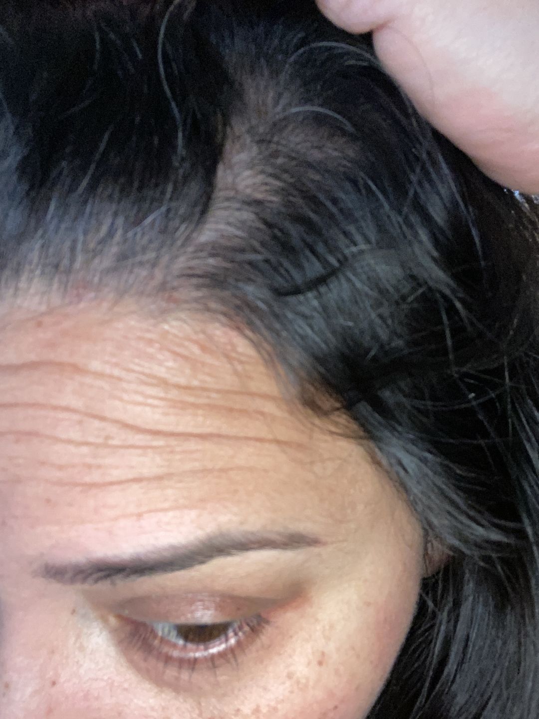Customer photo review of Psoriasis Honey Scalp Nourishing Kit