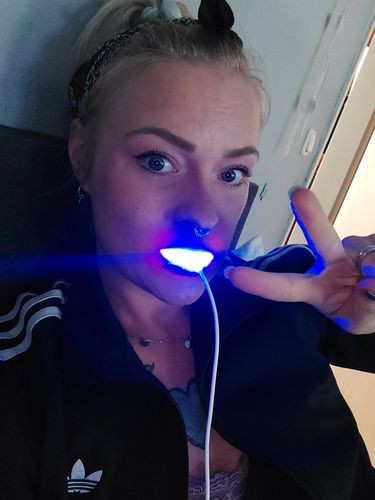 Customer photo review of PAP+ LED Teeth Whitening Kit