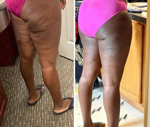 Customer photo review of Boldtique™ Anti-Cellulit Kroppsformsspray