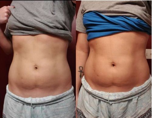 Customer photo review of Boldtique™ Anti-Cellulit Kroppsformsspray