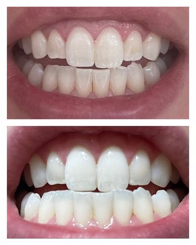Customer photo review of bedrō Whitening