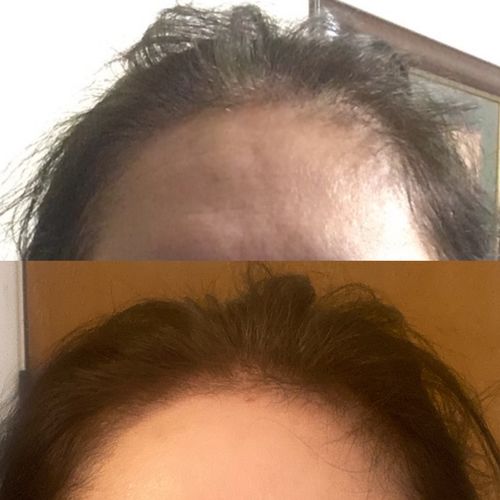 Customer photo review of DHT Blocker Vitamin with Immune Support, Saw Palmetto, and Green Tea