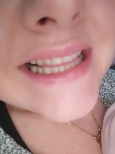 Customer photo review of PAP+ LED Teeth Whitening Kit