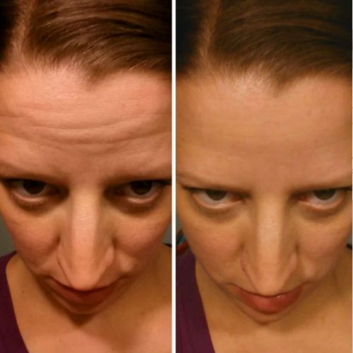 Customer photo review of Superlift™ Silicone Patches