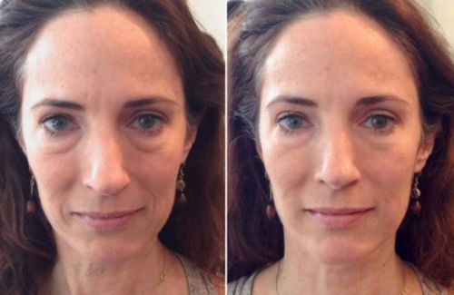 Customer photo review of Superlift™ Silicone Patches
