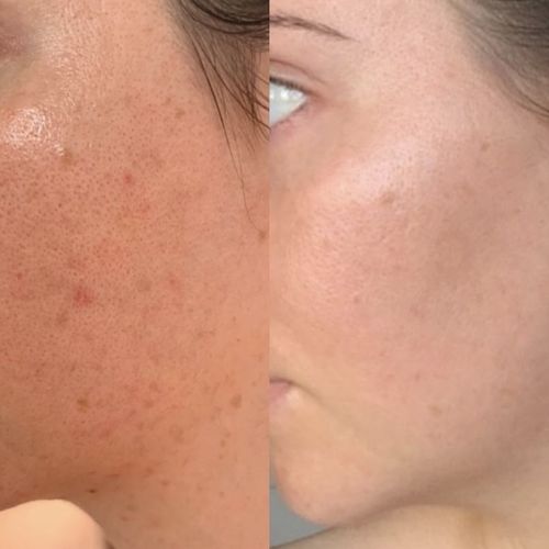 Customer photo review of Porenverfeinernde und reinigende Gesichtsmaske 100ml