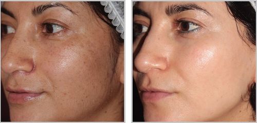 Customer photo review of Sontoes™ Anti-Age Hudserum