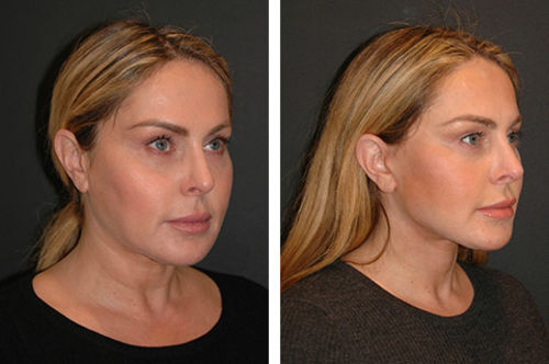Customer photo review of Sontoes™ Anti-Age Hudserum