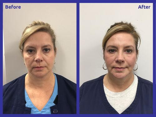 Customer photo review of Sontoes™ Anti-Age Hudserum