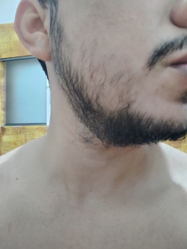 Customer photo review of Pack 2 Bálsamos para Crecimiento de Barba y Bigote Extra Fuerte Minoxidil 12% 100 ml