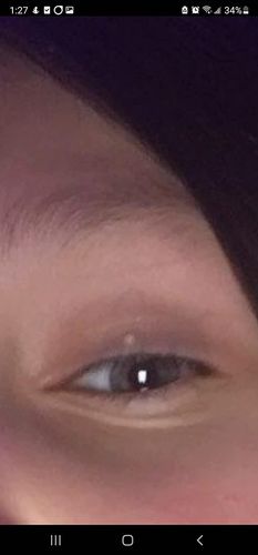 Customer photo review of Sontoes™ Milier Borttagningskräm