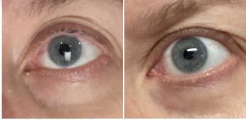 Customer photo review of Sontoes™ Milier Borttagningskräm