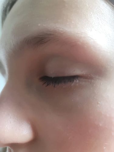 Customer photo review of Sontoes™ Milier Borttagningskräm
