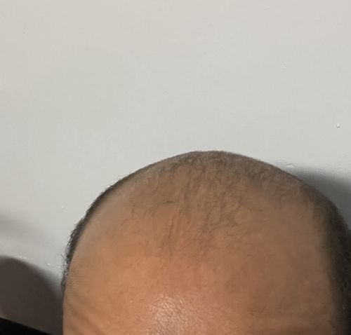 Customer photo review of India’s Secret Ancient Ayurvedic Hair Follicle Elixir (3 sizes)