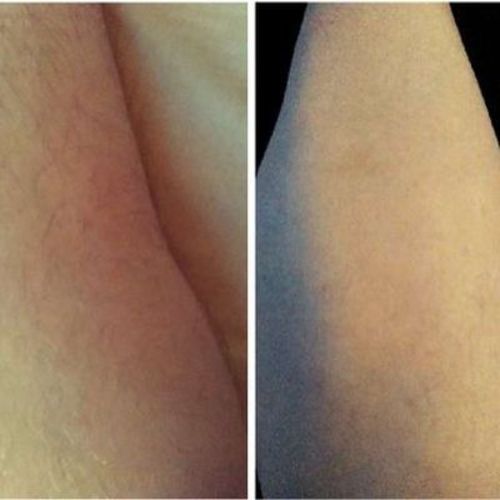 Customer photo review of HårAv™ Naturlig Permanent Hårborttagningsspray