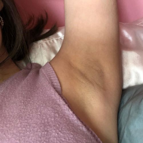 Customer photo review of HårAv™ Naturlig Permanent Hårborttagningsspray