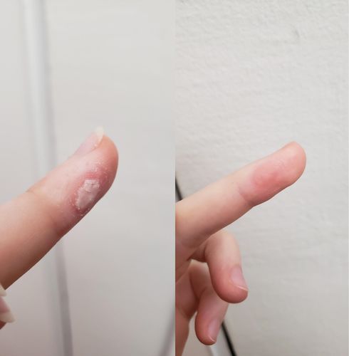 Customer photo review of Boldtique™ Vårtborttagningskräm