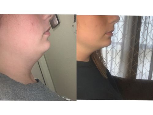 Customer photo review of SmalMask™