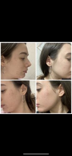 Customer photo review of Siero Acido Ialuronico + Vitamina C         -       2 al prezzo di 1 (30 ml a Siero)