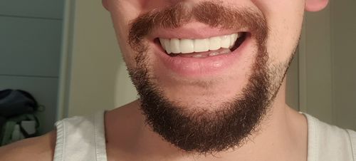 Customer photo review of Tooth-Veneer