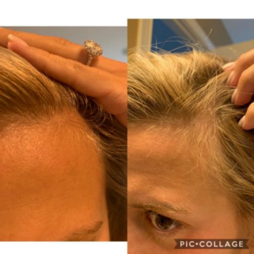 Customer photo review of Boldtique™ 7-dagars Hårväxtserum