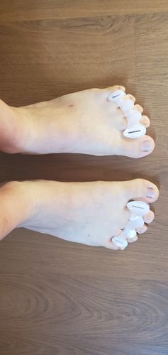 Customer photo review of Correct Toes®