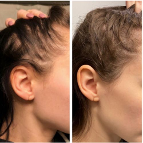 Customer photo review of Boldtique™ 7-dagars Hårväxtserum
