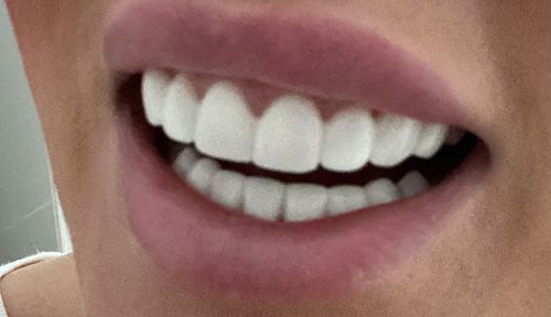 Customer photo review of Teeth-Veneer 2.0
