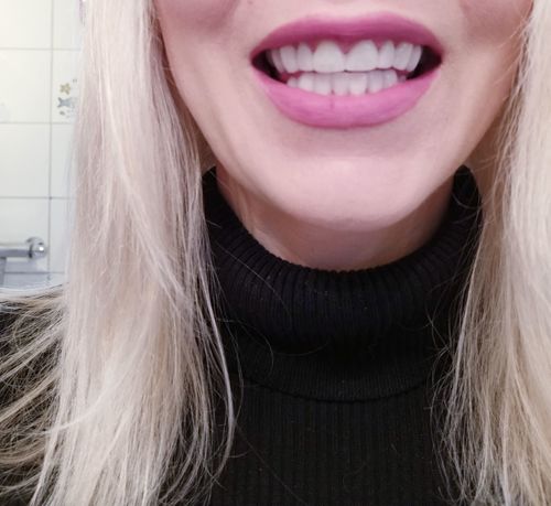 Customer photo review of Teeth-Veneer 2.0