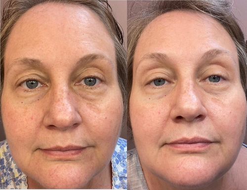 Customer photo review of PerfectionSerum™ Skin Rejuvination Serum