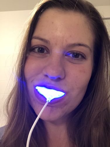 Customer photo review of PAP+ LED Teeth Whitening Kit
