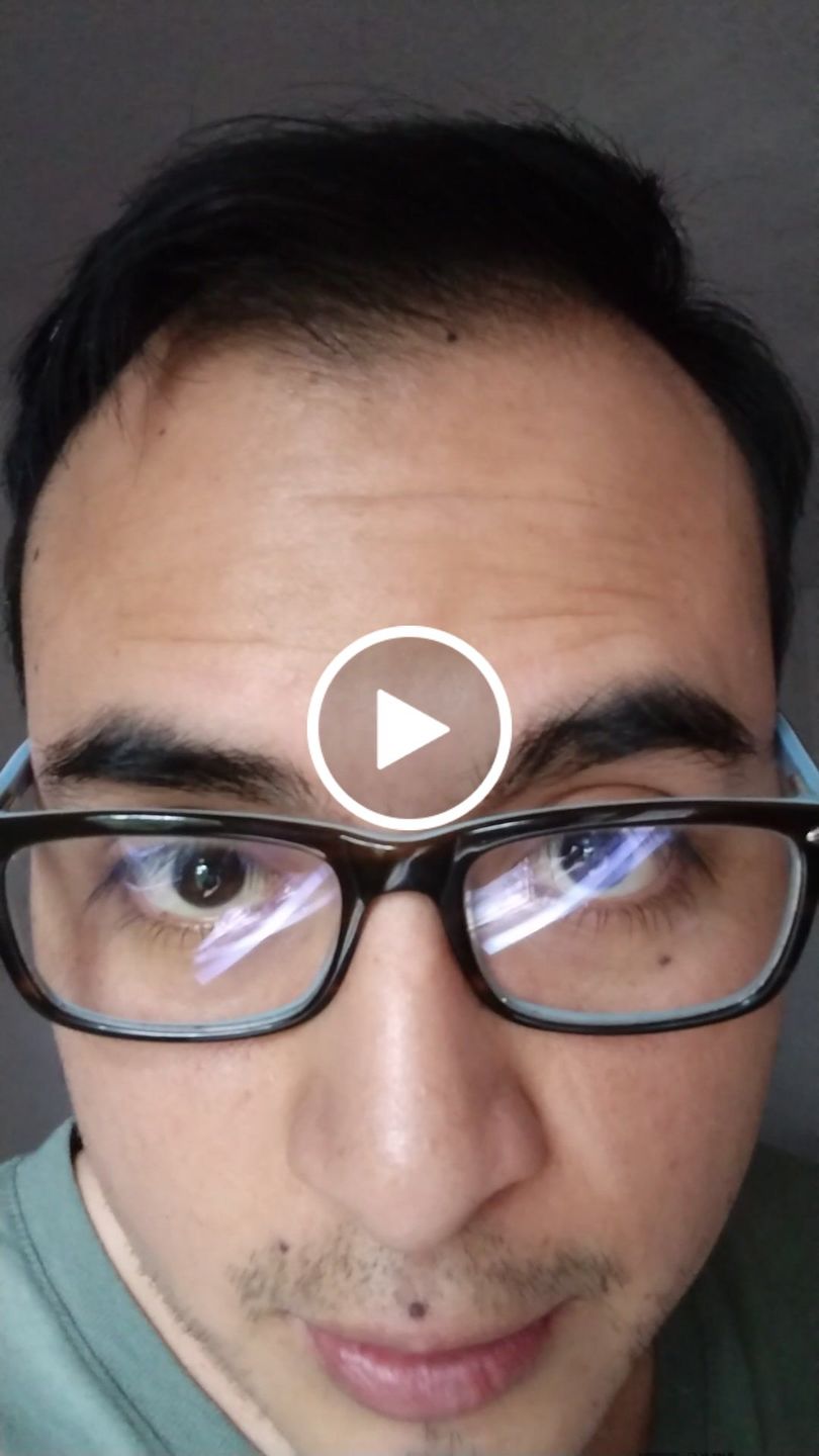 Customer video review of Kit Adiós Alopecia