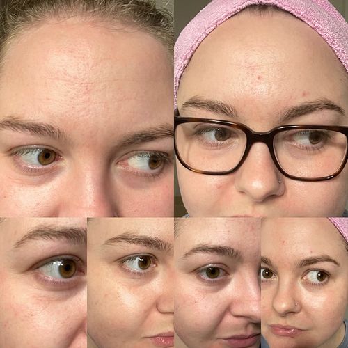 Customer photo review of AntiRynkor™ Fuktgivande Serum
