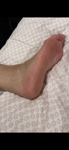 Customer photo review of LOVASKIN INSTANT FOOT PEEL Essential Kit - Great value, 25 uses in one bottle