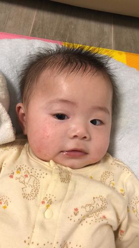 Customer photo review of Coco 全方位清爽護膚套裝 (濕疹修護霜+護膚乳霜+洗髮沐浴護膚露+蘆薈舒緩保濕凝膠)