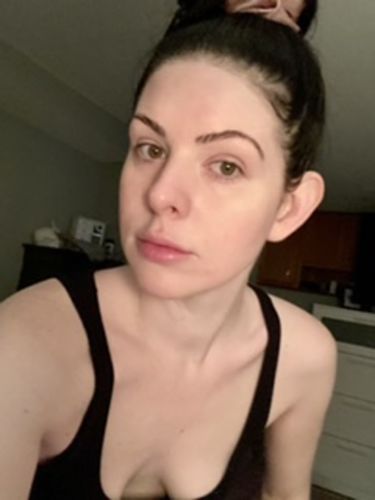Customer photo review of SkinFix: Microneedling