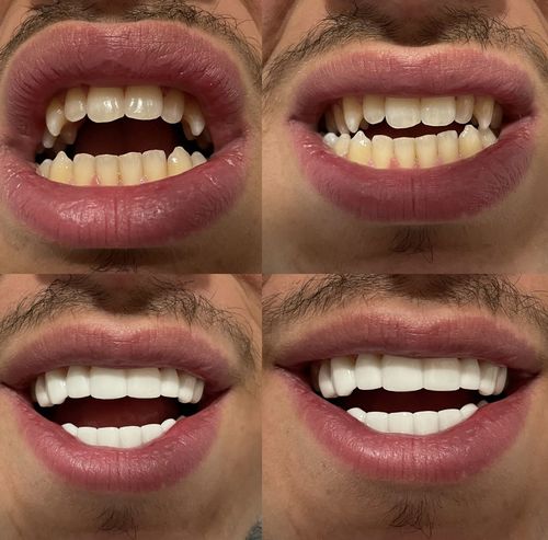 Customer photo review of Teeth-Veneer 2.0