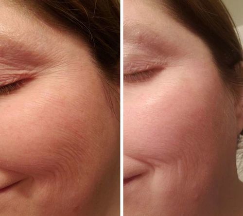 Customer photo review of Boldtique™ Anti-Age Rynkkräm