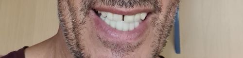 Customer photo review of Teeth-Veneer 2.0