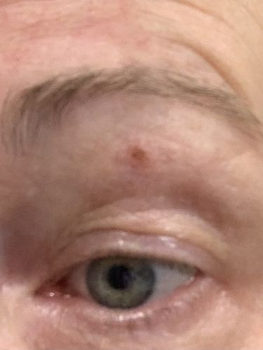 Customer photo review of Dermavel - Fibroblast Plasma Pen