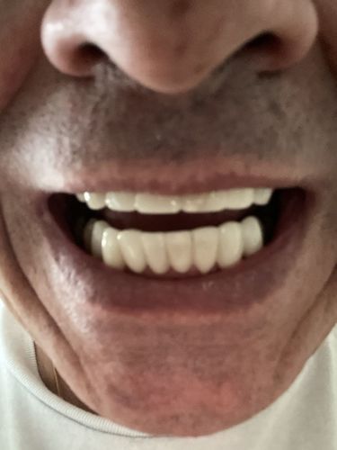 Customer photo review of Teeth-Veneer 2.0