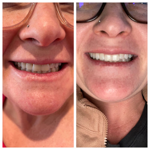 Customer photo review of bedrō Whitening