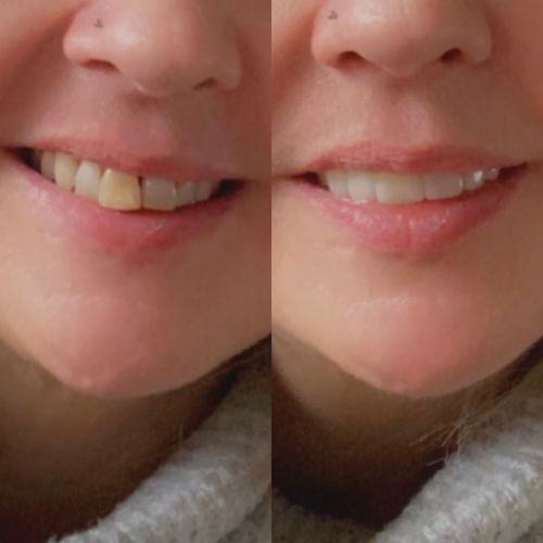 Customer photo review of Teeth-Veneer 2.0
