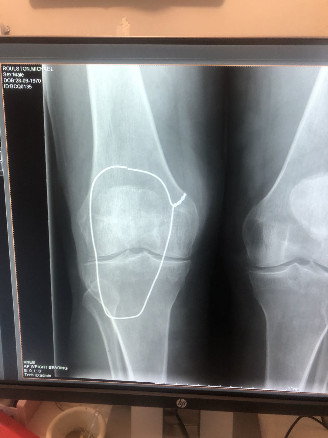Customer photo review of IceHug - Cold Compression Sleeve