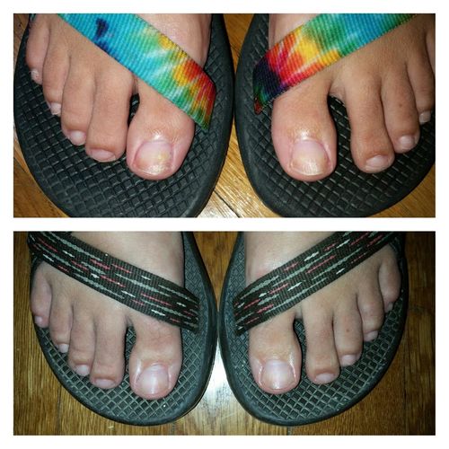 Customer photo review of AntiSvamp™ Borttagningsset