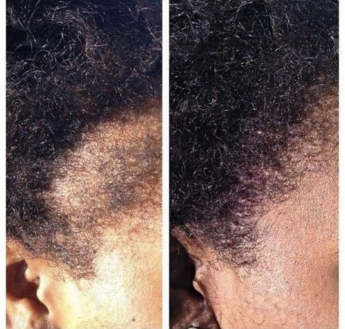Customer photo review of Extra Strength Hair Regrowth Serum