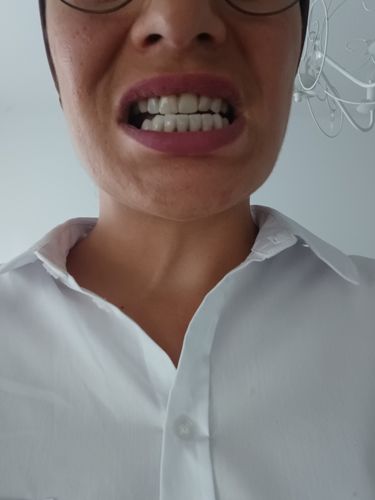 Customer photo review of Tooth-Veneer 2.0