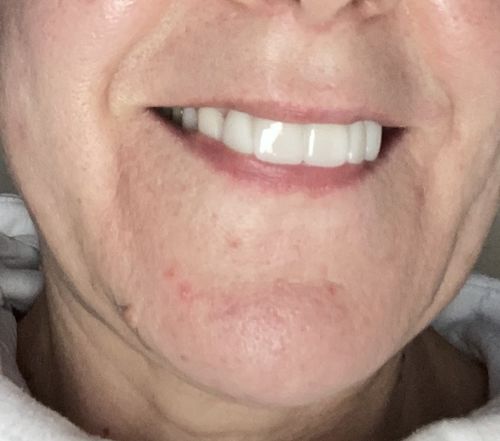 Customer photo review of Tooth-Veneer 2.0