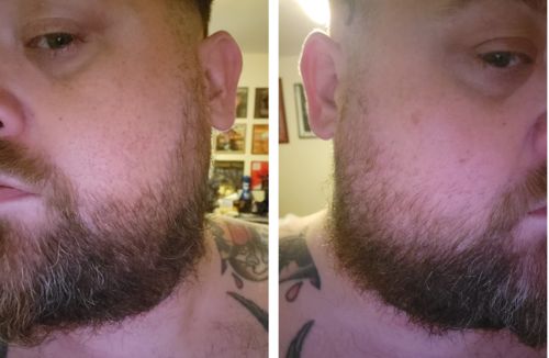 Customer photo review of SkäggVäxt™ Ultimata Skäggväxt Serum